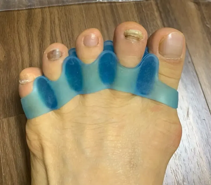 Buyer photo of blue gel toe spacers worn on bare feet